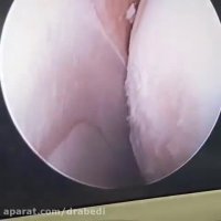 درمان پارگی منیسک