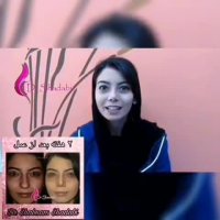 فیلم نتیجه جراحی بینی بعد از 3 هفته