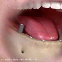 انیمیشن ایمپلنت دندان