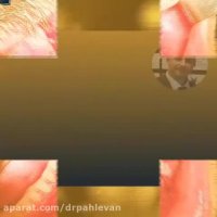 قراردهی ایمپلنت همزمان با پیوند استخوان