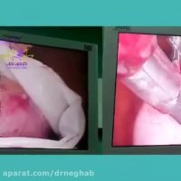 جراحی کیست تخمدان