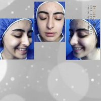 یک ماه بعد از جراحی بینی