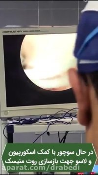 پارگی روت یا ریشه منیسک مدیال که تحت بازسازی و ترمیم