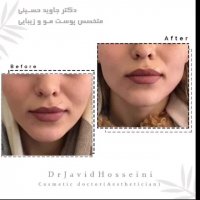 فیلم کانتورینگ زاویه فک