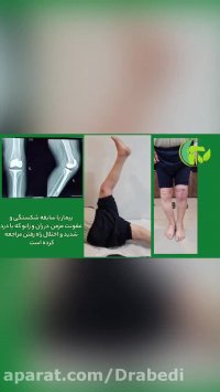 شکستگی ران و زانو