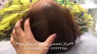 اجرای نچرال و طبیعی اسکالپ در خانمهایی که ریزش مو دارند