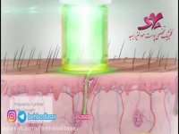 چگونگی اثر لیزر در تخریب موی زاید