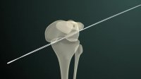 RIWObutton Implant for femoral fixation of ligament grafts