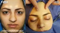 عمل بینی گوشتی توسط بهترین جراح بینی گوشتی تهران دکتر امید ابراهیمی