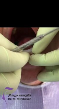 فیلم مراحل نصب لمینت دندان | جلسه دوم (نهایی)