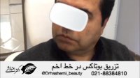 بوتاکس خط اخم پیشانی آقایان