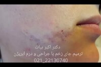 درم ابریژن چیست
