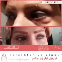 فیلم تزریق فیلر زیر چشم