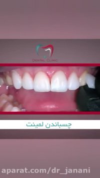 طریقه چسباندن لمینت دندان