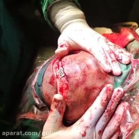 254. تروماتیک انسفالوسل اربیت و اتمویید