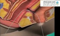 درمان فیستول مقعدی با لیزر بدون بازگشت در کلینیک زارعی