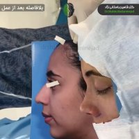 جراحی بینی مشکل توسط دکتر شاهین باستانی نژاد | جراح بینی تهران