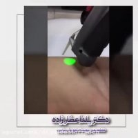 لیزر موهای زائد