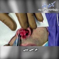 فیلم جراحی بینی