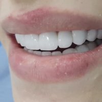 لمینت تمام سرامیکی-مرکز فوق تخصصی ایمپلنت