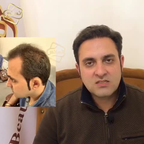 کاشت مو به روشSUT -کلینیک تخصصی رنسانس