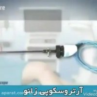 آرتروسکوپی زانو