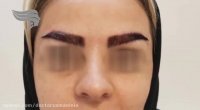 کاشت ابرو به سبک جدید