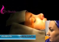 فیلم جراحی زیبایی بینی دکتر شادابی