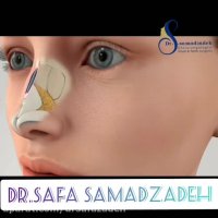 برداشتن قوز بینی در عمل بینی