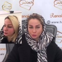 فیلم کاشت ابرو -کلینیک تخصصی رنسانس