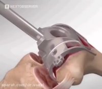 جراحی تعویض مفصل زانو