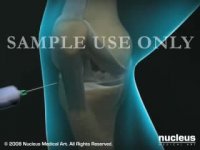 Knee Arthroscopy (Meniscectomy)