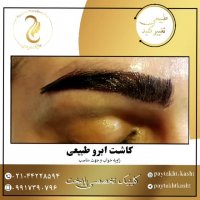 کاشت ابرو طبیعی | کلینیک پایتخت | 44228594-021