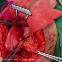 عمل برداشت تومور پل فوقانی کلیه راست