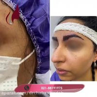 فیلم واقعی کاشت ابرو با طرح دلخواه