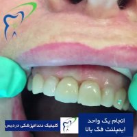 انجام یک واحد ایمپلنت دندانی