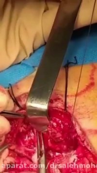 تومور پاروتید (غدد بزاقی)