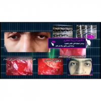 تحسین المرضی بعد جراحه بالمنظار