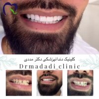 هزینه ونیر کامپوزیت