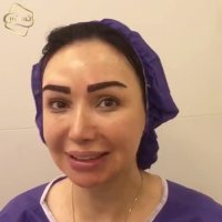 کاشت ابرو طبیعی