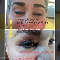 مزوتراپی آموزش مزوتراپی بوتاکس رفع چین و چروک ایران زمین