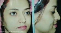 جراحی زیبایی بینی توسط بهترین جراح بینی دکتر امید ابراهیمی