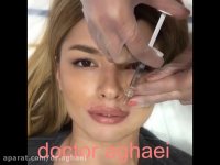 تزریق ژل لب