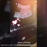 شنیدن صدای قلب جنین در سونوگرافی