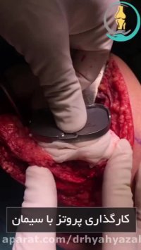 دو ماه بعد از عمل جراحی زانو