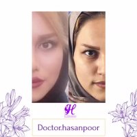 نتیجه جراحی بینی بعد از دو هفته