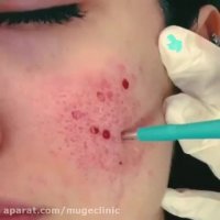 رفع جای جوش با پانچ