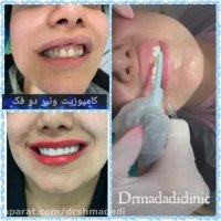 کامپوزیت دندان هر دو فک