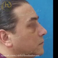 فیلم عمل جراحی بینی مردانه و نتیجه ی آن