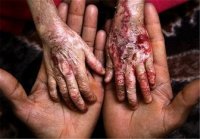 پیدا و پنهان بیماران نادر